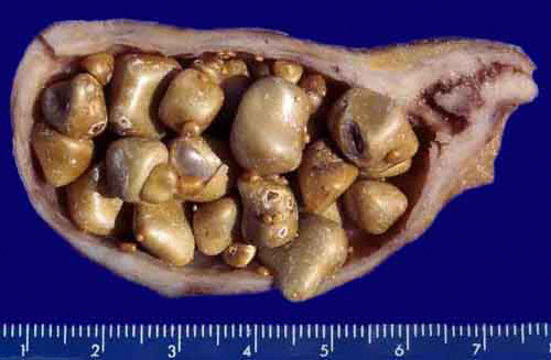 Gallbladder with Papillary Adenocarcinoma (gross)