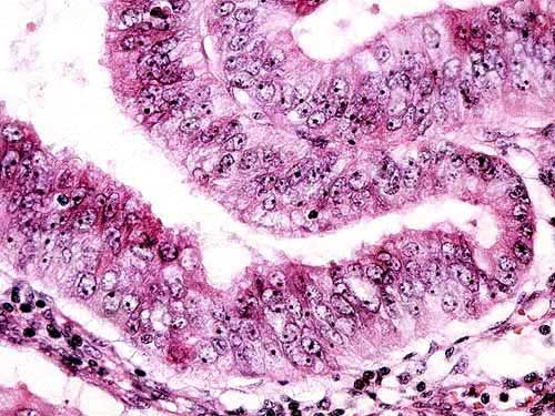 Endometrial Biopsy  - 400x