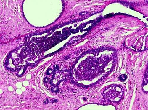Breast Biopsy - 100x