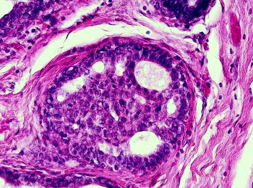 Breast Biopsy - 400x