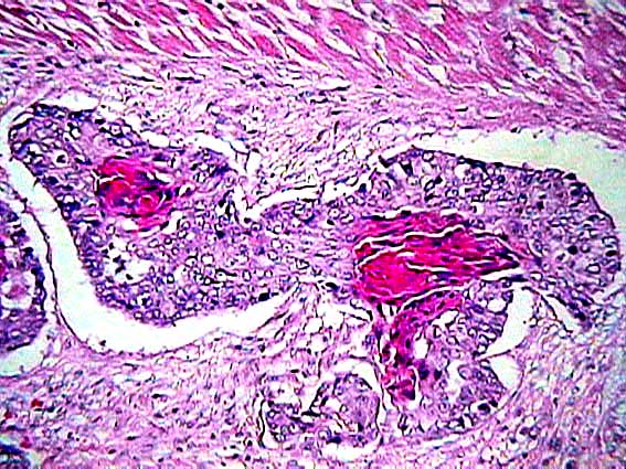 Corazón con tumor metastásico