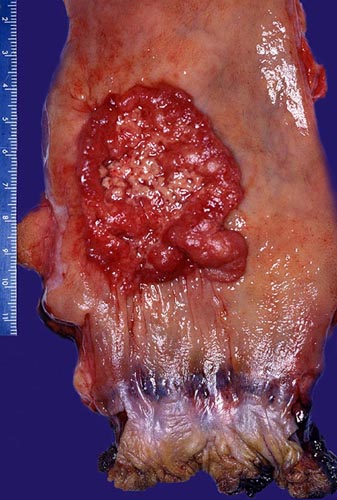 Rectum with Adenocarcinoma (gross)